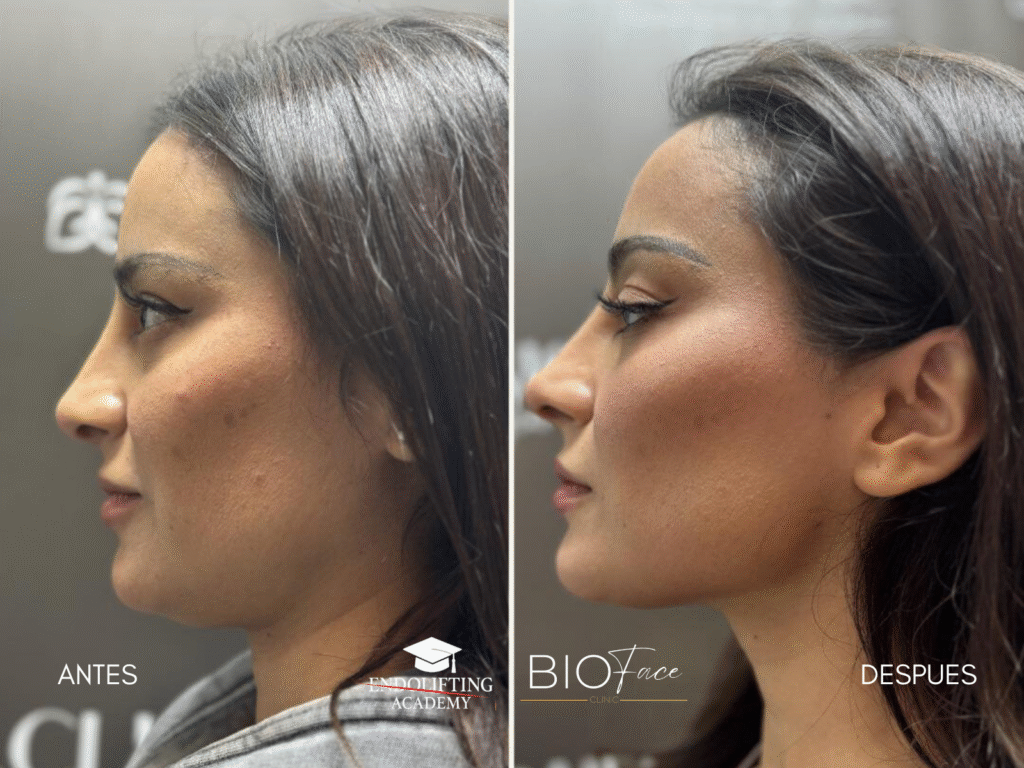 ENDOLIFTING FACIAL WORKSHOP