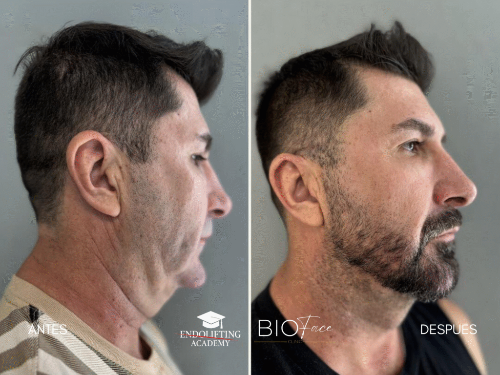 ENDOLIFTING FACIAL WORKSHOP
