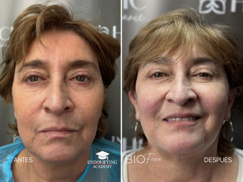 ENDOLIFTING FACIAL WORKSHOP