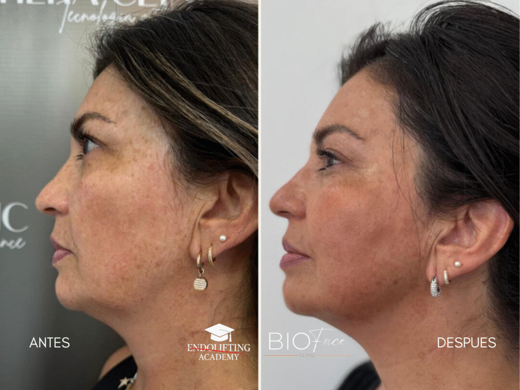 ENDOLIFTING FACIAL WORKSHOP