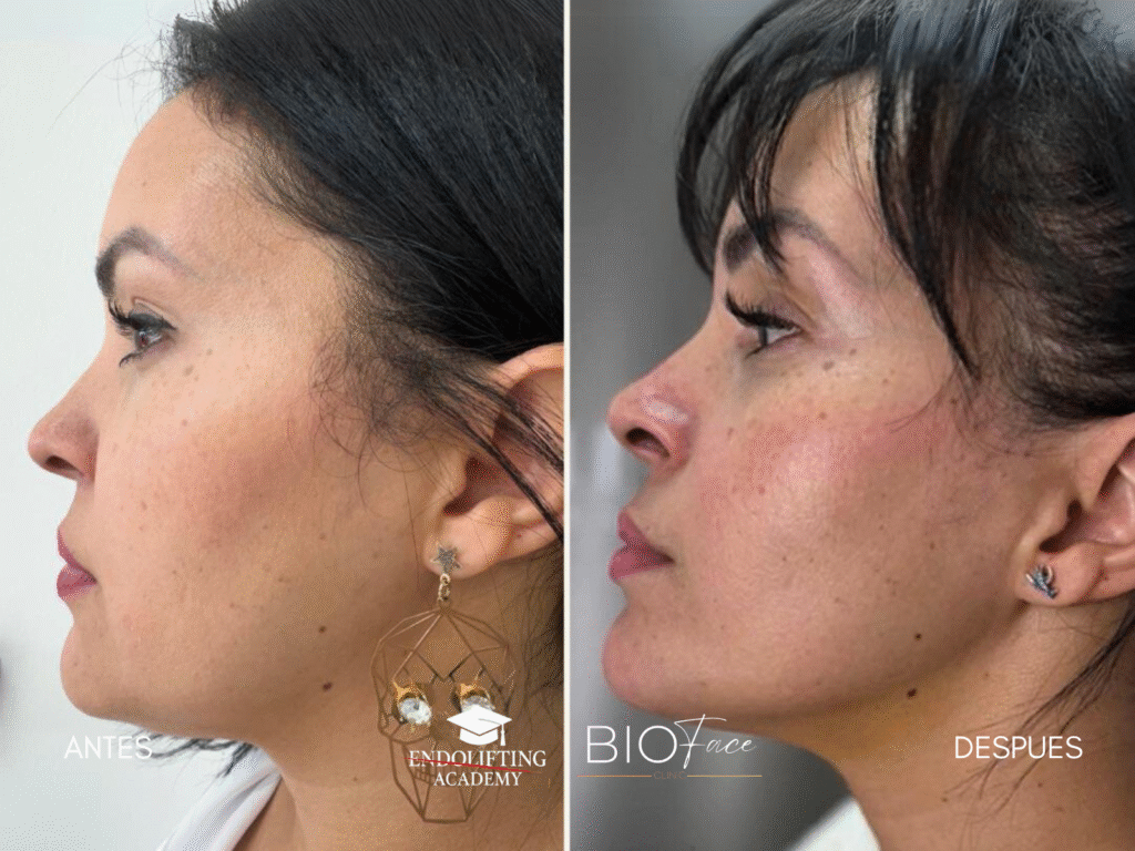 ENDOLIFTING FACIAL WORKSHOP