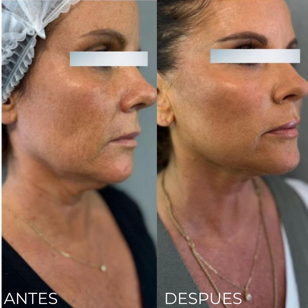 Endolifting Ultralift Antes y Después Resultado 2