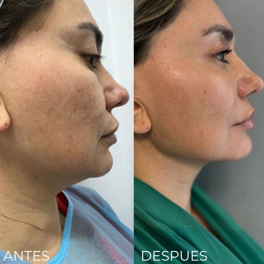 Endolifting Ultralift Antes y Después Resultado 3