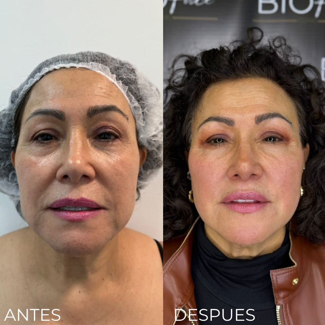 Endolifting Ultralift Antes y Después Resultado 4