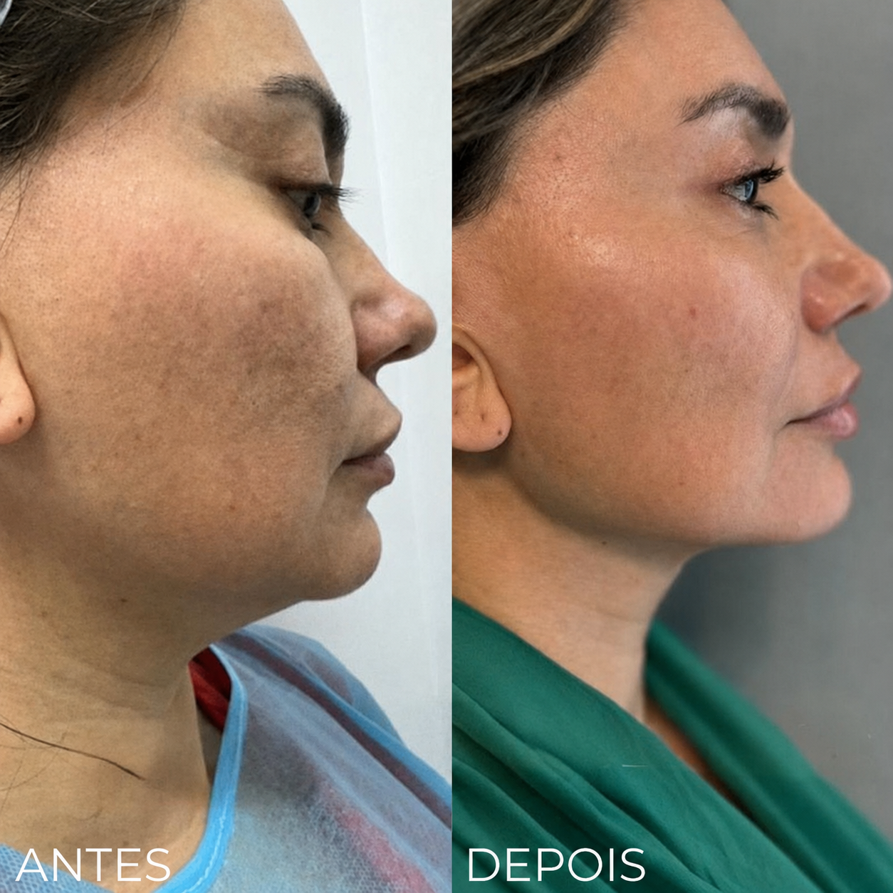 Endolifting Ultralift Antes e Depois Resultado 1