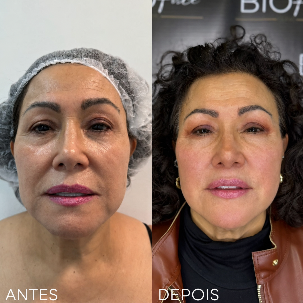 Endolifting Ultralift Antes e Depois Resultado 2