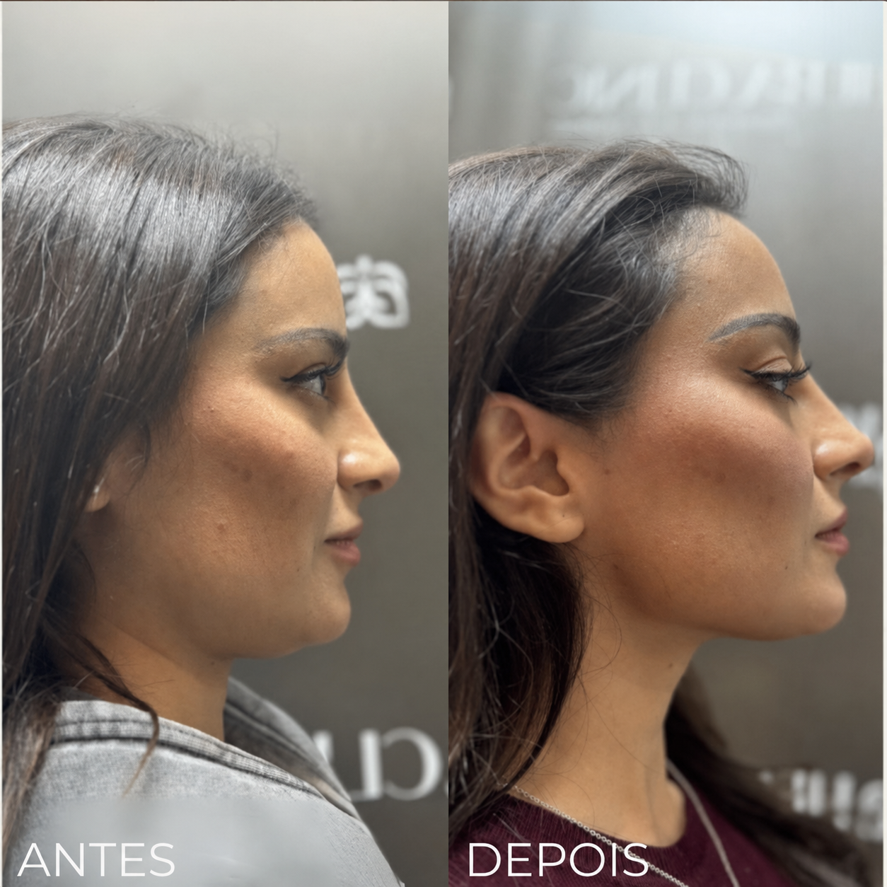 Endolifting Ultralift Antes e Depois Resultado 3