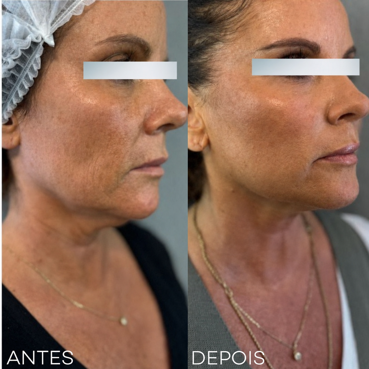 Endolifting Ultralift Antes e Después Resultado 4